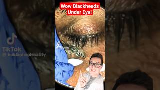 Crazy BLACKHEAD REMOVAL UNDER EYE  How Did This Happen shorts [upl. by Fiorenze]