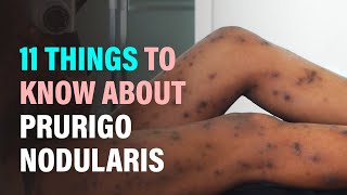 11 Things to Know About Prurigo Nodularis Nodular Prurigo [upl. by Maretz989]