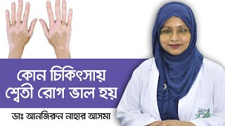 কোন চিকিৎসায় শ্বেতী রোগ ভালো হয়  Vitiligo Treatment in Bangladesh [upl. by Leila985]