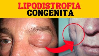 LIPODISTROFIA CONGÉNITA FACIAL  Que Es [upl. by Cissie]