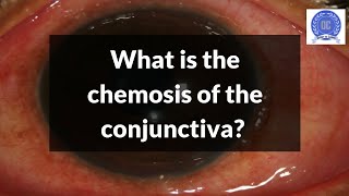 What is Conjunctival Chemosis [upl. by Tama]