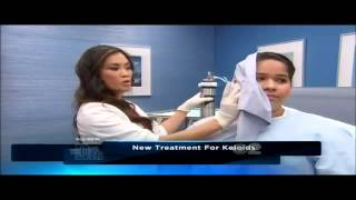 Keloid amp Hypertrophic Scar treatment using Cryoshape on quotThe Doctors TVquot [upl. by Noloc]