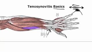 Tenosynovitis Basics Your Doctor Doesnt Tell You [upl. by Yffub]