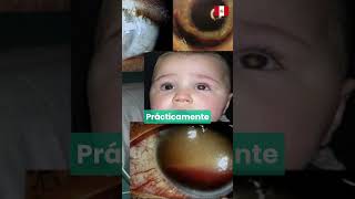 Tumor en el ojo  Retinoblastoma [upl. by Otinauj]