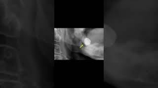 Dentigerous cyst xray virlshorts [upl. by Gnoh]