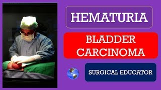 BLADDER CARCINOMA How To DIAGNOSE amp TREAT  HEMATURIA [upl. by Midan148]