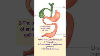 Riglers triad  Gall stone ileus [upl. by Nileuqcaj]