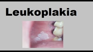 Leukoplakia [upl. by Karilla296]