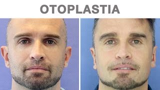 Otoplastia antes y después  Testimonio de David [upl. by Rednaxela208]