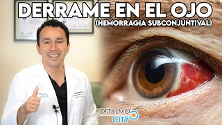 Derrame  Sangrado en el OJO 👁 ¿Por qué aparece y cómo se quita [upl. by Smoht]