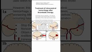 Treatment of intracerebral hemorrhage after thrombotic therapy [upl. by Neerual193]