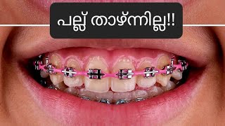 പല്ല് താഴ്ന്നില്ല pallil kambi idunnath malayalam braces pallil kambi  kambi  dental palludr [upl. by Ogg16]