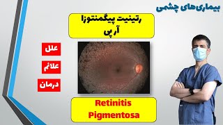 رتینیت پیگمنتوزا، آر پی Retinitis Pigmentosa [upl. by Nedda]