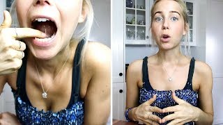 My Tongue Tie Surgery Experience [upl. by Baylor]