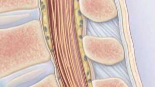 Comment pratiquer une ponction lombaire [upl. by Profant]