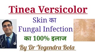 Tinea Versicolor Skin Infection ka 100 Treatment [upl. by Ffilc]