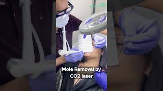 Mole Removal by CO2 Laser [upl. by Nnylassej]