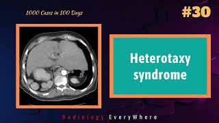 Heterotaxy Syndrome Radiology Tutorial  1000 cases in 100 Days  Video 30 [upl. by Selestina300]