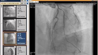 How Can I Play ANGIOGRAM CD In Windows PC [upl. by Tyrus463]