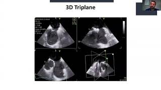 Evaluation of atrial septal defects and guidance for transcatheter closure [upl. by Eetak]