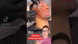 Shocking CHEMICAL PEEL  Next Level Phenol Peel shorts [upl. by Adniral574]