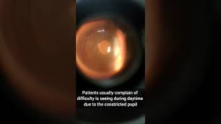 Posterior polar cataract [upl. by Dent]