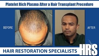 African American Hair Loss  Platelet Rich Plasma After a Hair Transplant Procedure [upl. by Yecaw71]