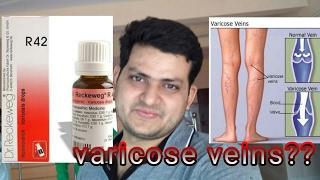 Homeopathic medicine for varicose veins explain [upl. by Dreddy]