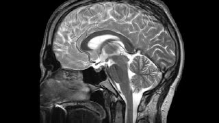 The Ventricles Neuroanatomy Video Lab  Brain Dissections [upl. by Narat368]