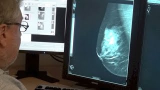 Do 3D mammograms improve breast cancer screening [upl. by Angus999]