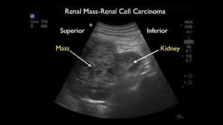 Ultrasound detection of a renal mass in a patient with flank pain and hematuria [upl. by Ainnat]