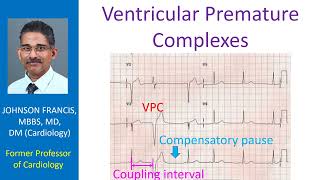 Ventricular Premature Complexes [upl. by Regazzi365]